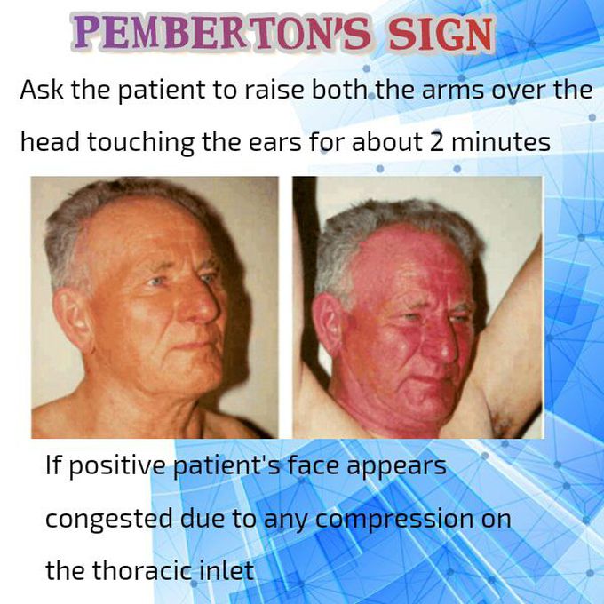 Seen in Retrosternal goitre