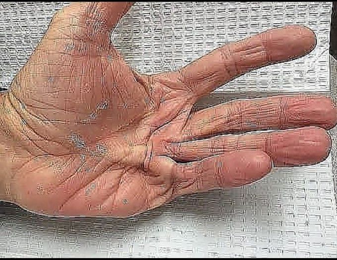 Dupuytren's Contracture