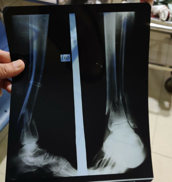 Tibia/Fibula Fracture