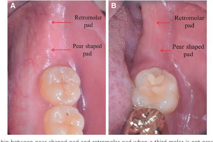 Retromolar pad