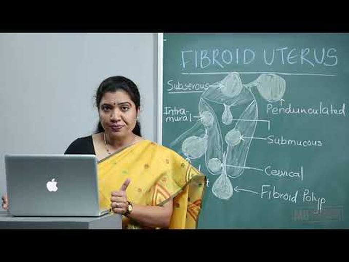 Uterine Fibroids (Leiomyomas) - Part 1