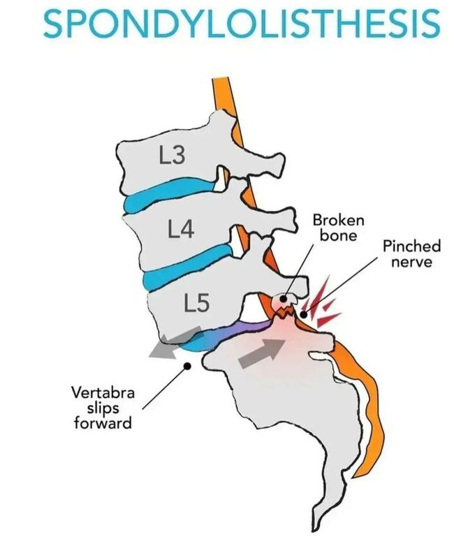 Spondylolisthesis