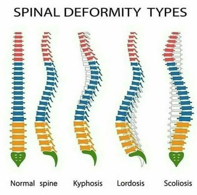 Spinal deformity