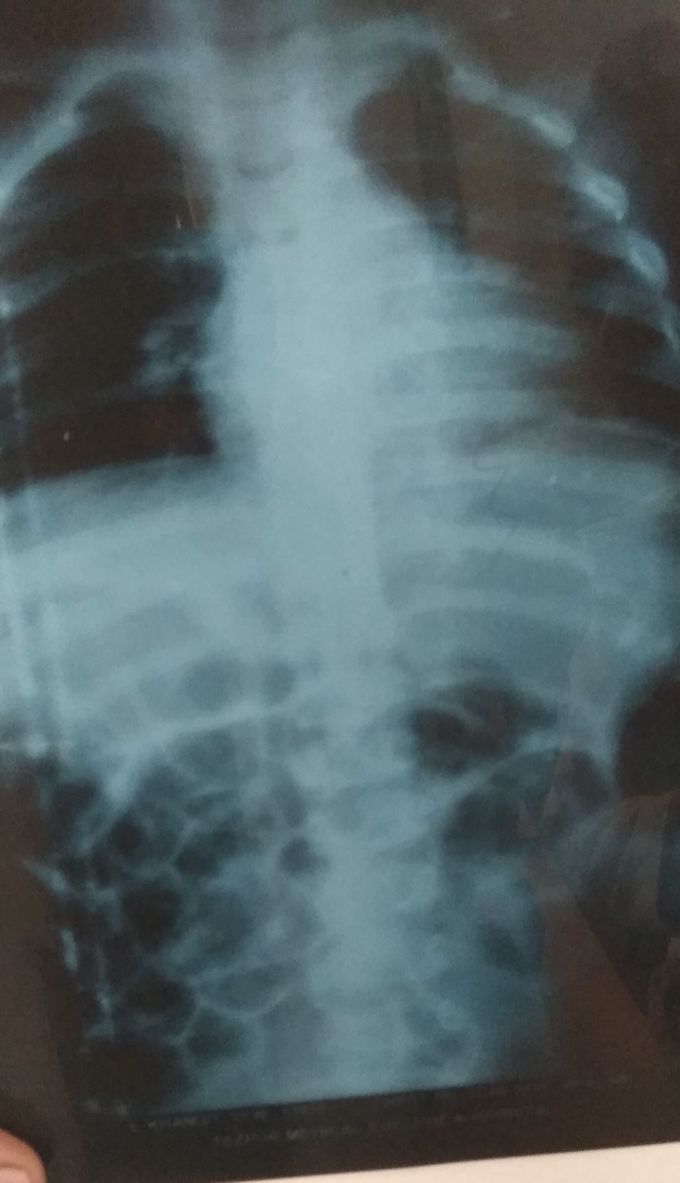 Hirschsprung's Disease