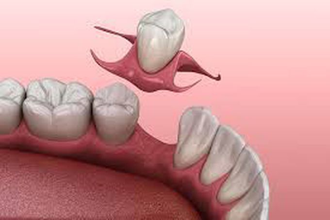 Disadvantages of partial denture