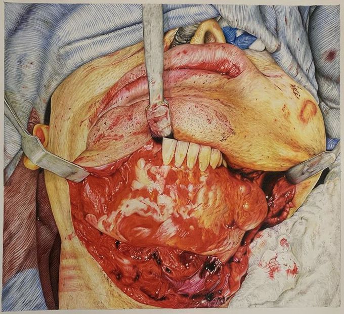 Medical illustration of a submandibular surgical approach