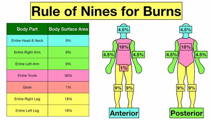 Rule of nine for burns