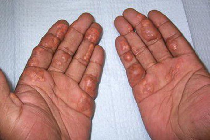 Symptom of Palmar xanthoma