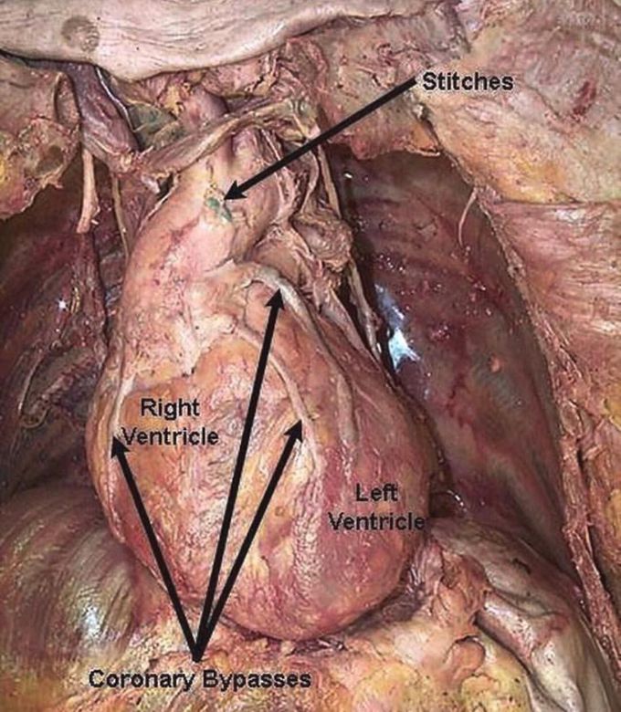 Coronary By-pass 