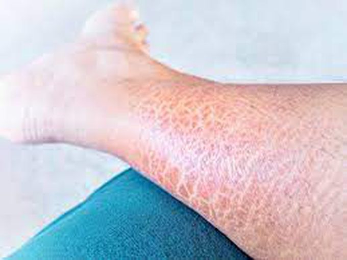 How is ichthyosis vulgaris treated?