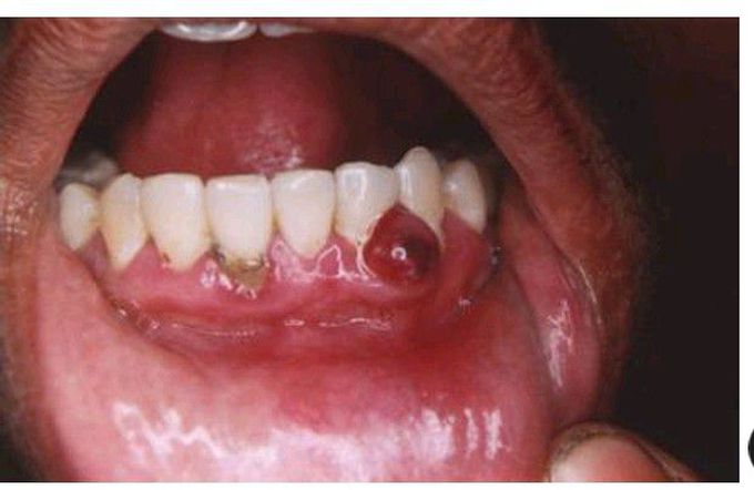Gingival abscess