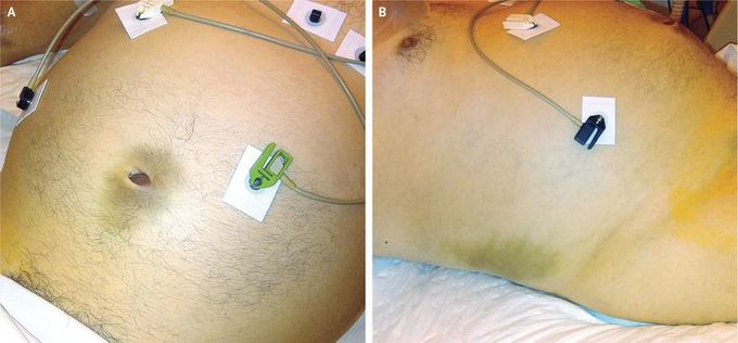 Cullen’s and Grey Turner’s Signs in Acute Pancreatitis