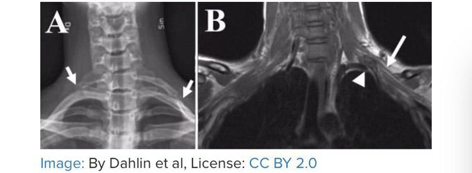 Which of the following is the expected neurological symptoms that this patient will mostly have in her left hand?