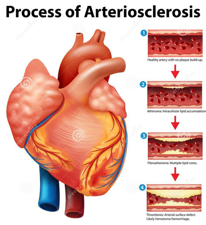 Process of Arteriosclerosis