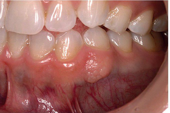 Intramucosal Melanocytic Nevus