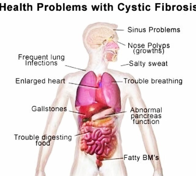 Cystic fibrosis