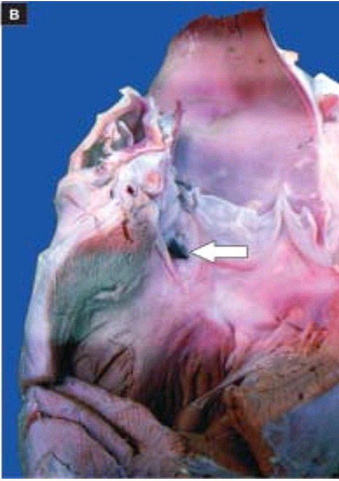 Ventricular septal defect.