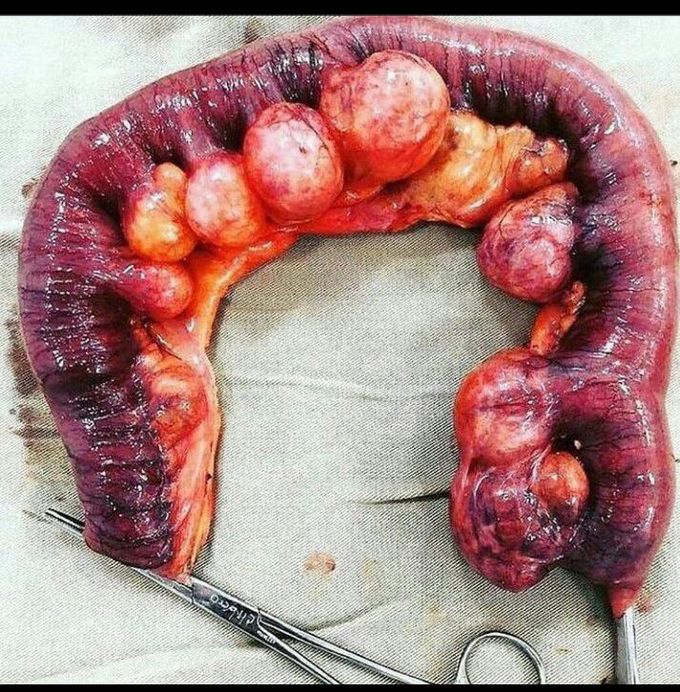 Diverticulosis