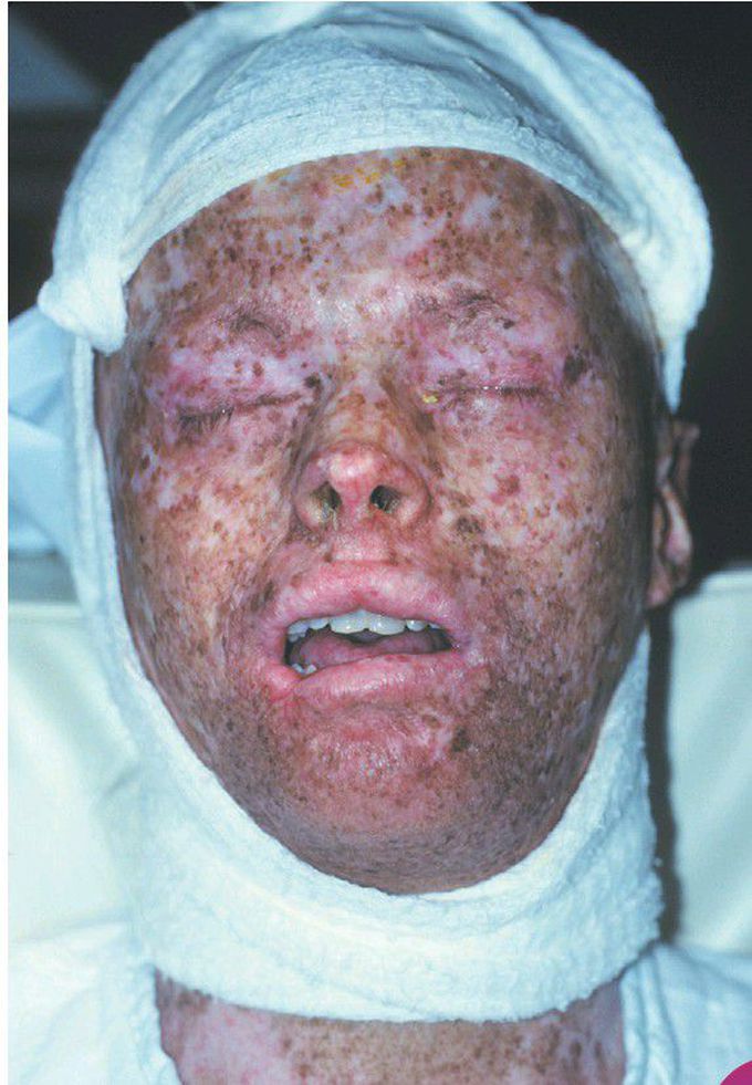 Xeroderma Pigmentosum.