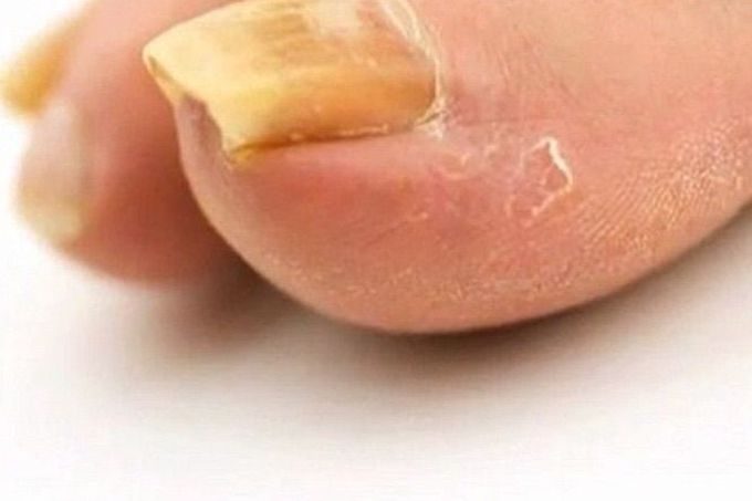 Yellow Toenails