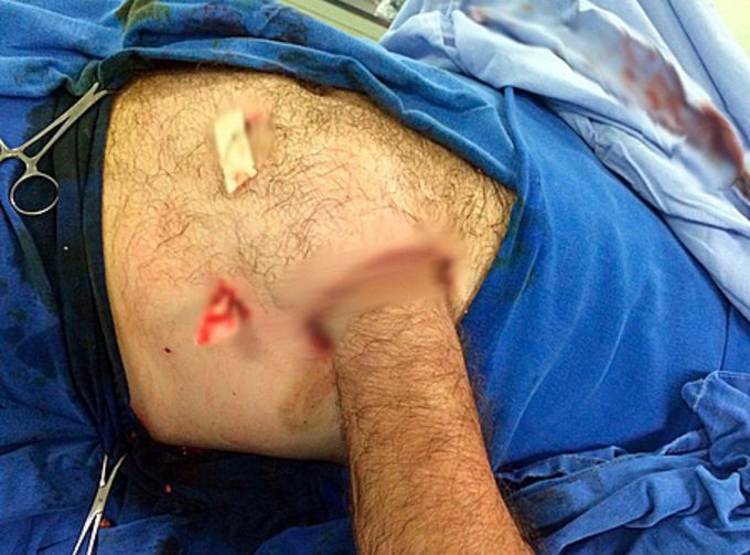 Abdominal flap for hand reconstruction!! 