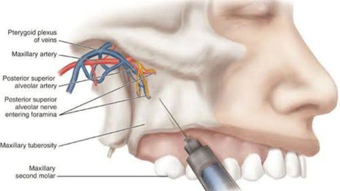 Types of dental anesthesia