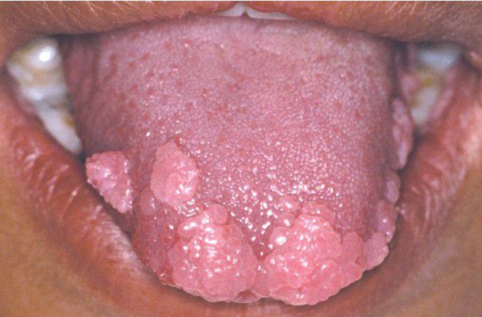 Multifocal Epithelial Hyperplasia