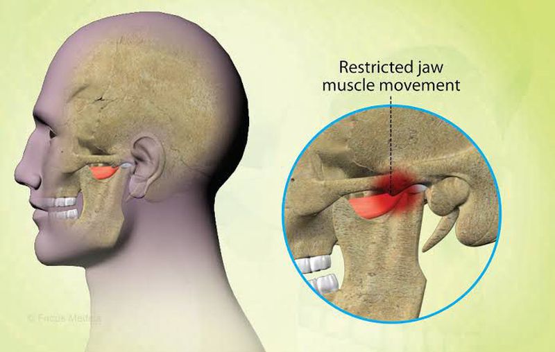 Jaw and TMJ pain illustration