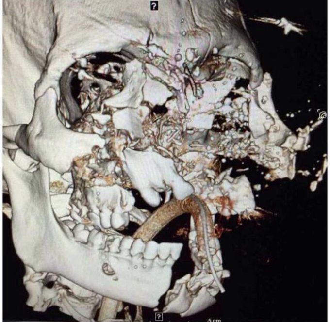 Face reconstruction