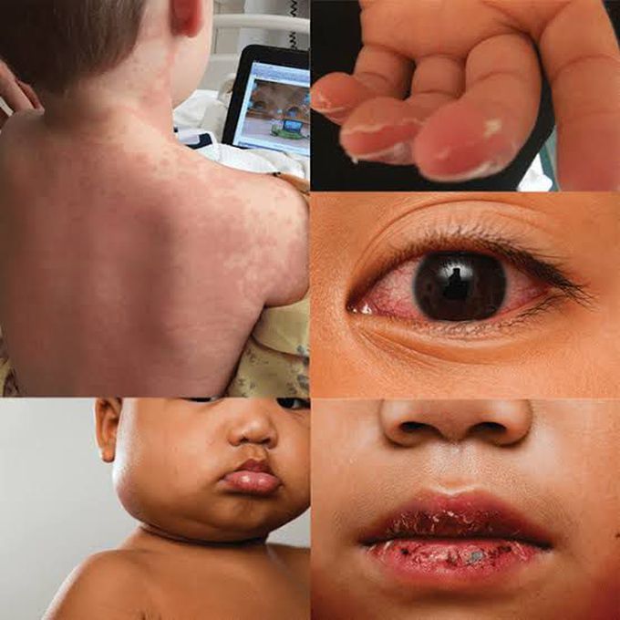 Kawasaki disease