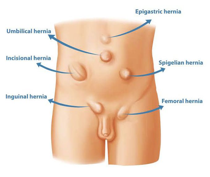 Location of Hernias