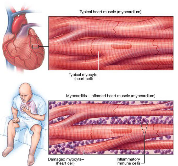 Cause of Myocarditis