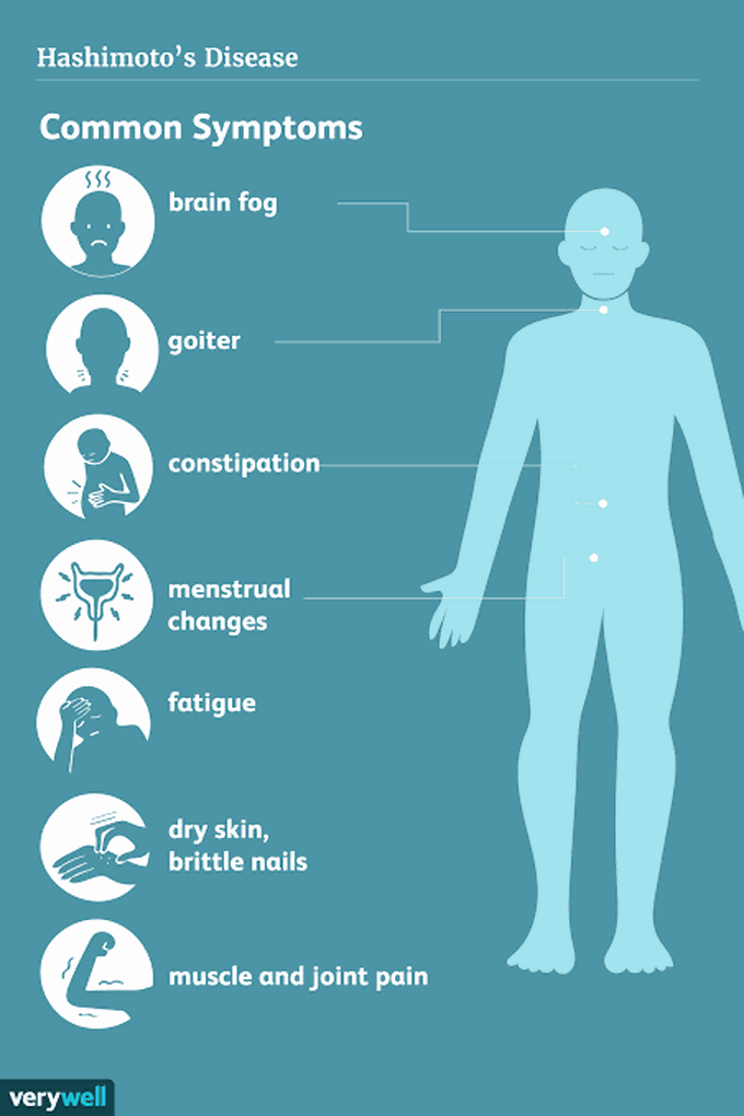 Causes of hashimotos thyroiditis and symptoms