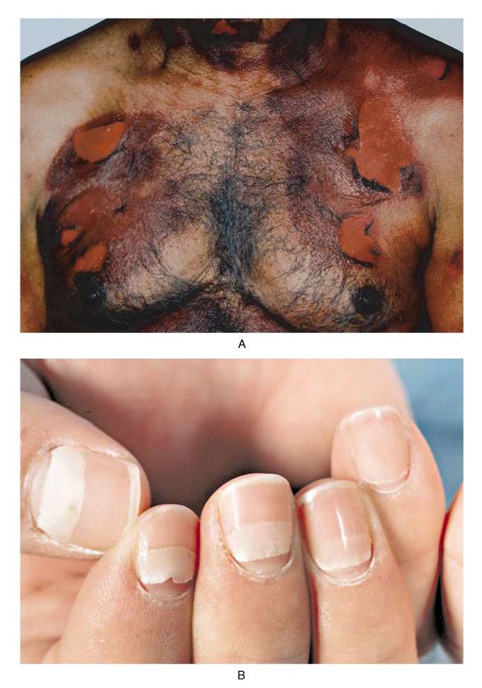 Toxic Epidermal Necrolysis
