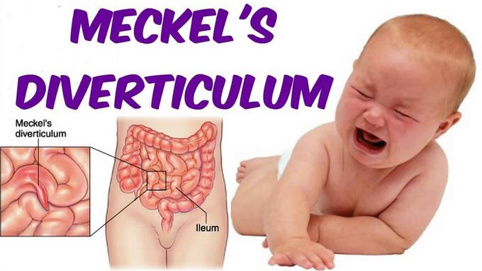 Symptom of Meckel's diverticulum