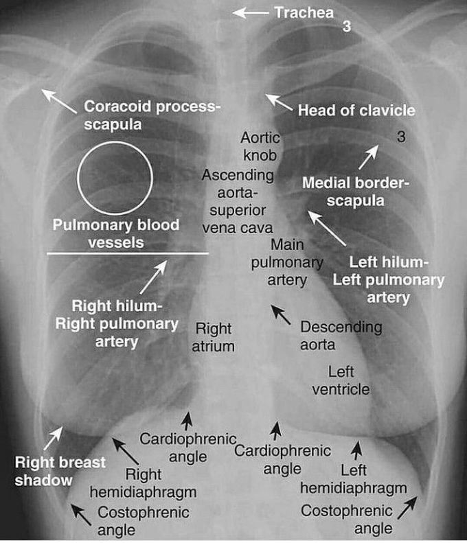Chest X-ray interpretation