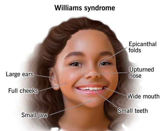 These are the symptoms of Williams syndrome