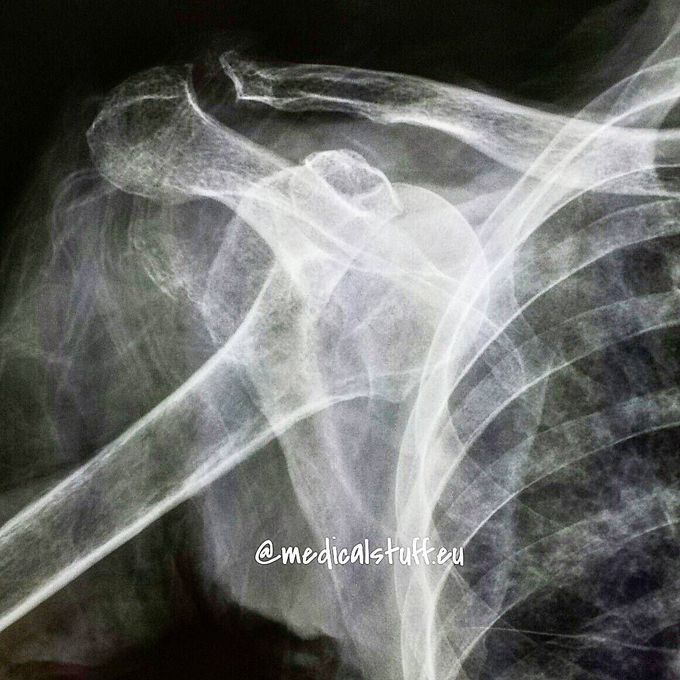 Back side shoulder dislocation