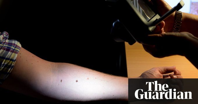 Computer learns to detect skin cancer more accurately than doctors