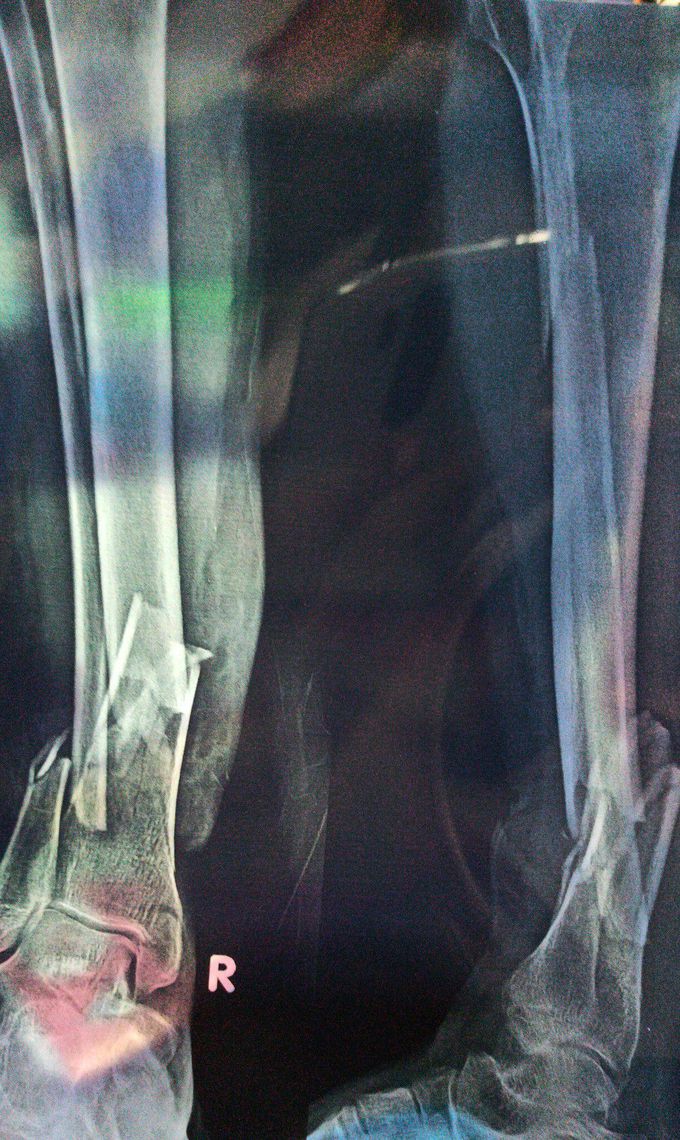 Bone fracture