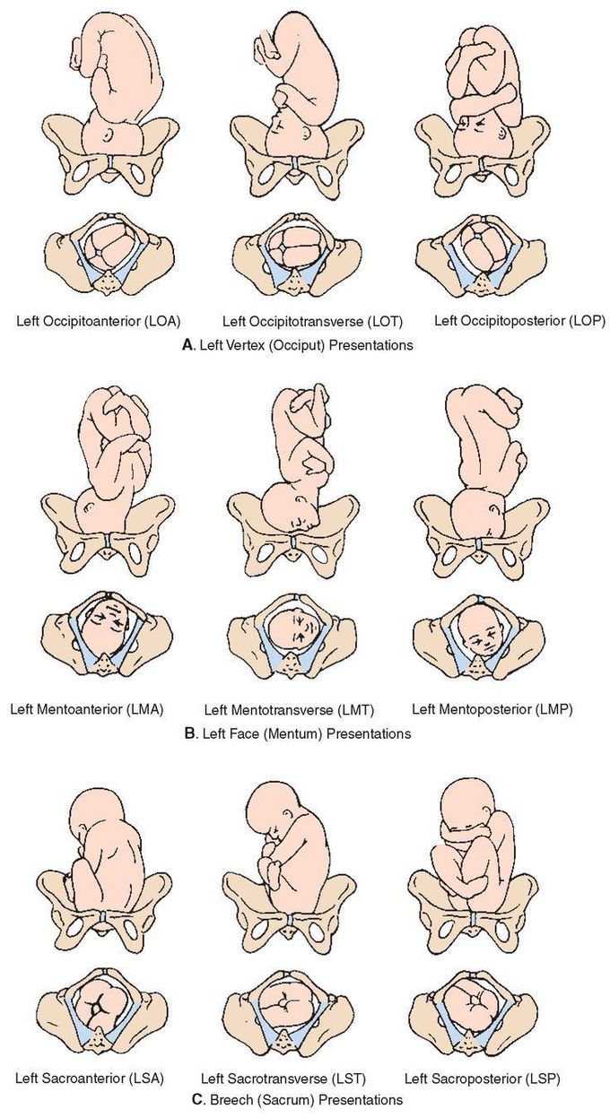 attitude of fetus in breech presentation