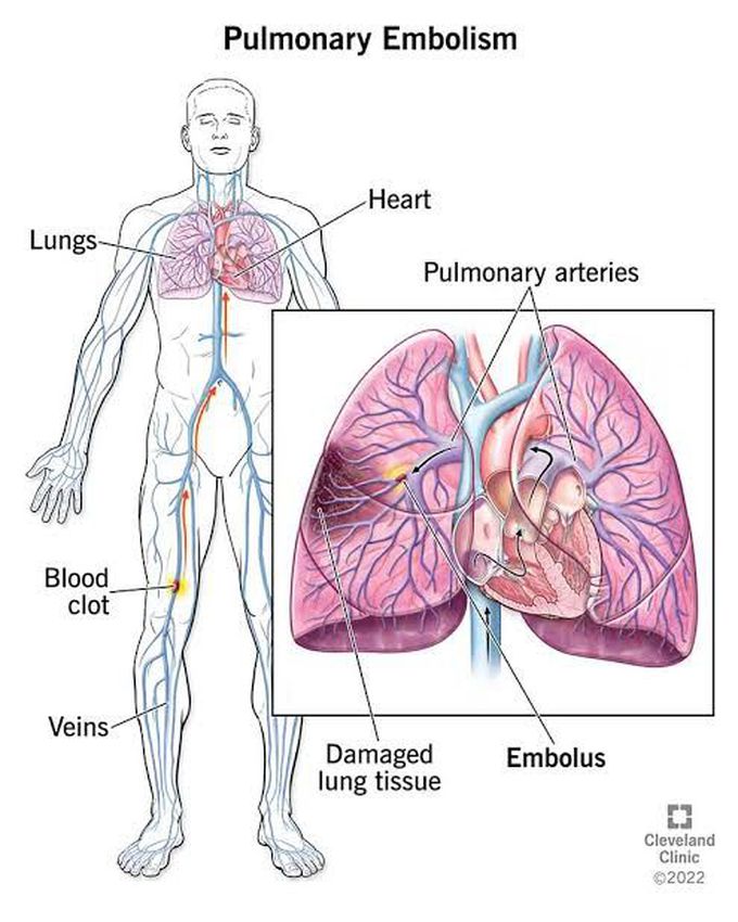 Side effects of treatment of pulmonary embolism