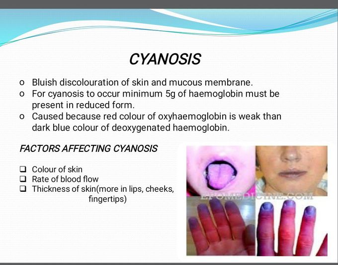 Cyanosis