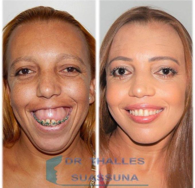 Orthognathic Surgery