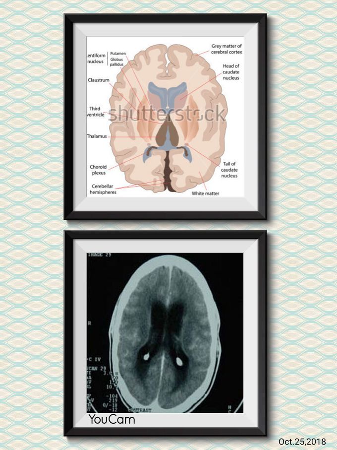 Brane par to mri