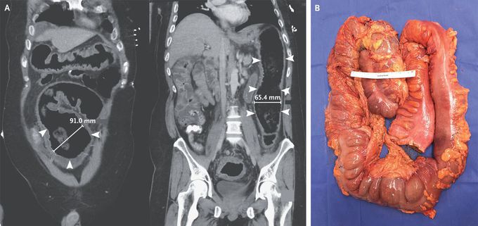 Toxic Megacolon Due to Fulminant Clostridioides difficile Infection