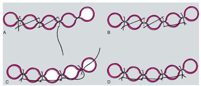 Multiple sutures