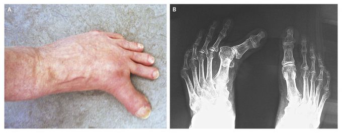 Hallux Varus