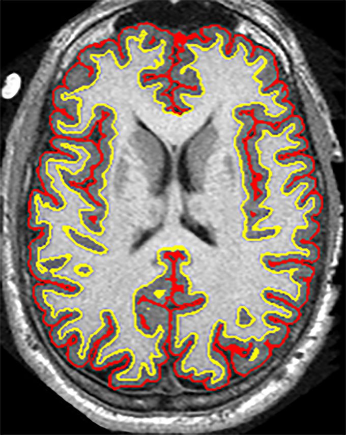 Study finds multiple sclerosis drug slows brain shrinkage
