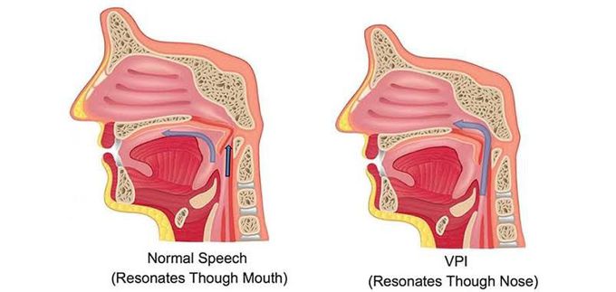 Causes of velopharyngeal insufficiency